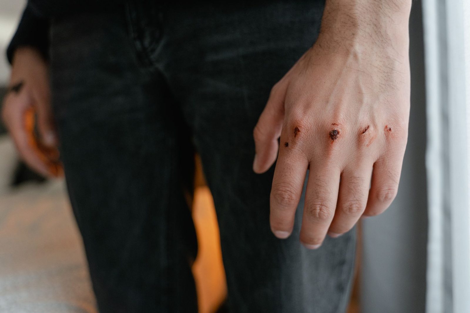 Hand with scratch marks on the skin